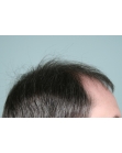 Before Hair Transplant&nbsp;2 Sessions (Areas)